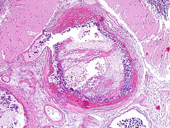 1G5 Lymphoma, intravascular (Case 1) H&E 6.