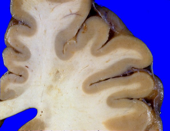 2A4 Lymphoma, intravascular (Case 2) 15