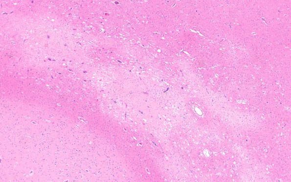 2B2 Lymphoma, intravascular (Case 2) H&E 4X