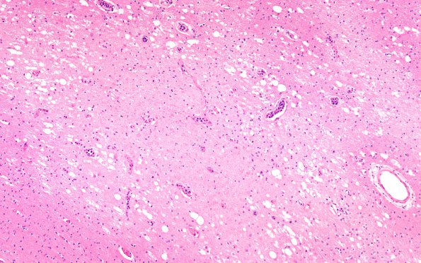 2B3 Lymphoma, intravascular (Case 2) H&E 20X