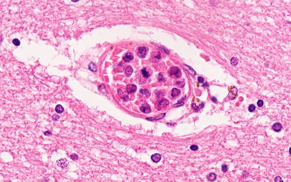 2B5 Lymphoma, intravascular (Case 2) H&E 100X