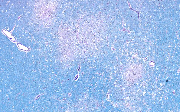 2D1 Lymphoma, intravascular (Case 2) N13 LFB-PAS 4X 2