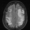 3A1 Lymphoma, intravascular (Case 3) FLAIR 2 - Copy