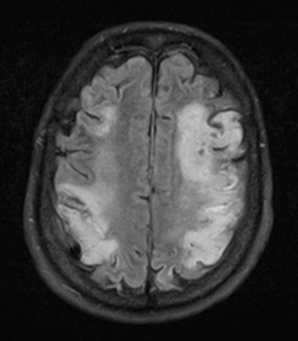 3A1 Lymphoma, intravascular (Case 3) FLAIR 2 - Copy