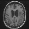 3A2 Lymphoma, intravascular (Case 3) T1 without contrast - Copy