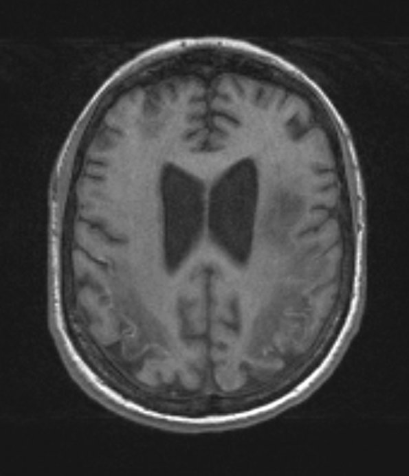 3A2 Lymphoma, intravascular (Case 3) T1 without contrast - Copy