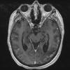 3A3 Lymphoma, intravascular (Case 3) T1 with contrast - Copy