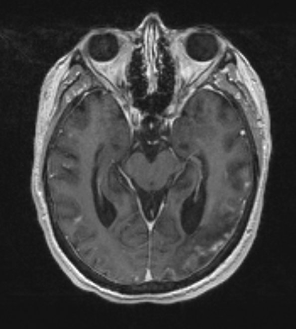 3A3 Lymphoma, intravascular (Case 3) T1 with contrast - Copy