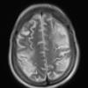 3A4 Lymphoma, intravascular (Case 3) T2 2 - Copy