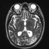 3A5 Lymphoma, intravascular (Case 3) T2 with contrast - Copy