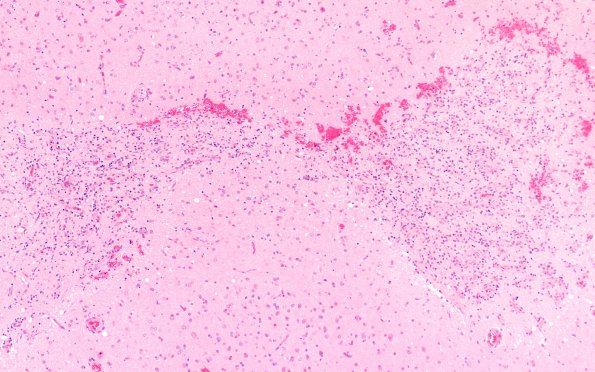 3B1 Lymphoma, intravascular (Case 3) H&E A 10X new 10X