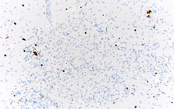 3B10 Lymphoma, intravascular (Case 3) Ki67 IHC