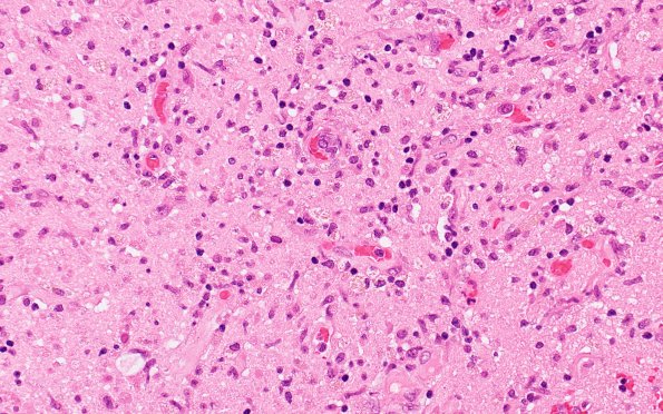 3B2 Lymphoma, intravascular (Case 3) H&E 3