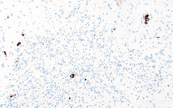 3B4 Lymphoma, intravascular (Case 3) CD20 4