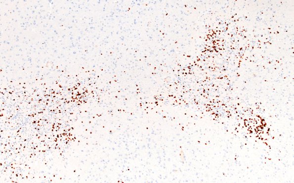 3B5 Lymphoma, intravascular (Case 3) CD3 fnl A