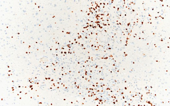 3B6 Lymphoma, intravascular (Case 3) CD3 fnl A 20X