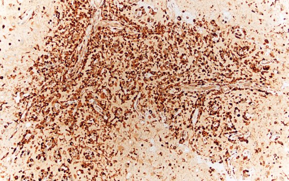 3B8 Lymphoma, intravascular (Case 3) CD68fnl A 20X new 10X 3