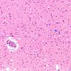 3C1 Lymphoma, intravascular (Case 3) H&E 7 copy