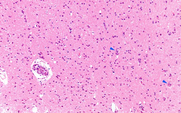 3C1 Lymphoma, intravascular (Case 3) H&E 7 copy