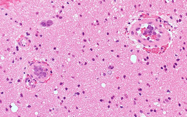 3C2 Lymphoma, intravascular (Case 35) H&E 10