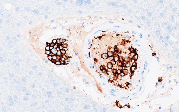 3C3 Lymphoma, intravascular (Case 3) CD20 1