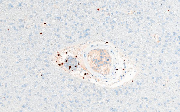 3C4 Lymphoma, intravascular (Case 3) CD3 5