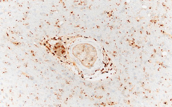 3C5 Lymphoma, intravascular (Case 3) CD68 20X