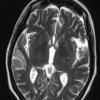 4A1 Lymphoma, IV (Case 4) myelitis T2 W 1 - Copy