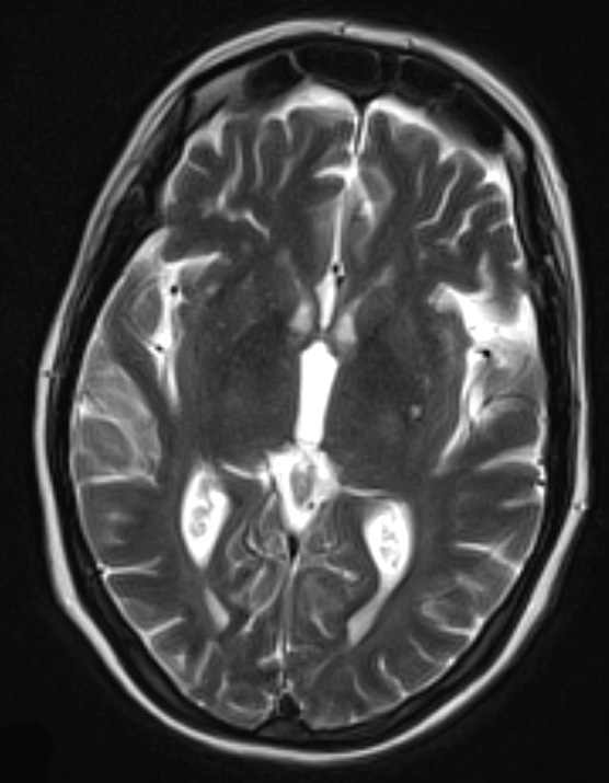 4A1 Lymphoma, IV (Case 4) myelitis T2 W 1 - Copy