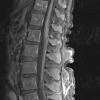 4A2 Lymphoma, IV (Case 4) myelitis T1 W - Copy