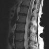 4A3 Lymphoma, IV (Case 4) myelitis T2 - Copy