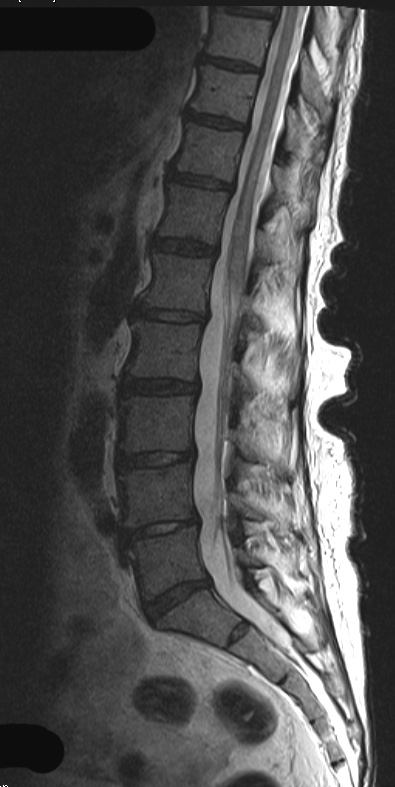 4A3 Lymphoma, IV (Case 4) myelitis T2 - Copy