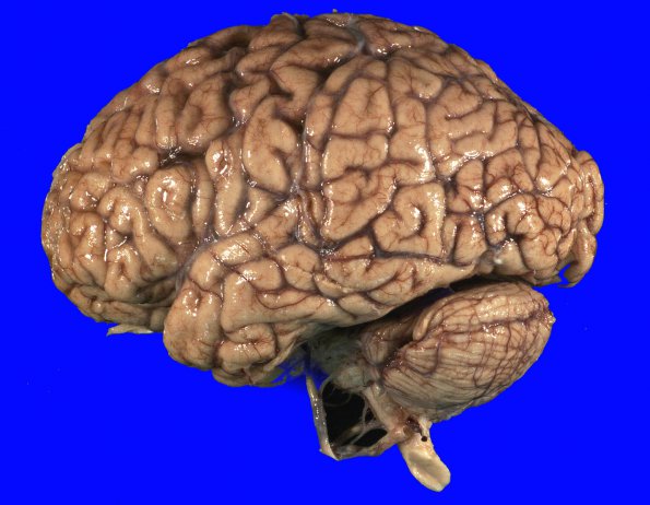 4B1 Lymphoma, IV (Case 4) myelitis 3