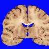 4B2 Lymphoma, IV (Case 4) myelitis 8