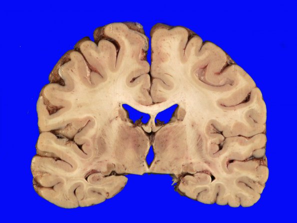 4B2 Lymphoma, IV (Case 4) myelitis 8