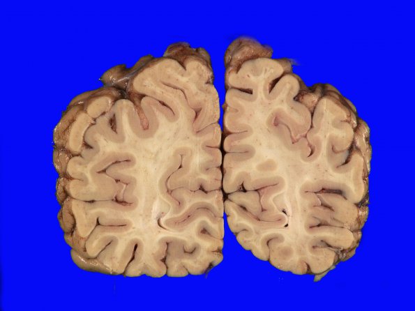 4B3 Lymphoma, IV (Case 4) myelitis 9