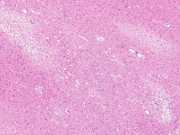 4C1 Lymphoma, IV (Case 4) myelitis cortex 6