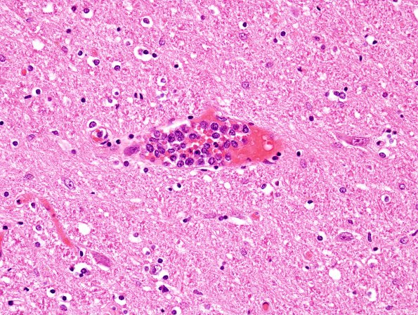 4C2 Lymphoma, IV (Case 4) myelitis cortex 3