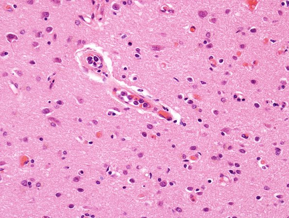 4C3 Lymphoma, IV (Case 4) myelitis cortex 7