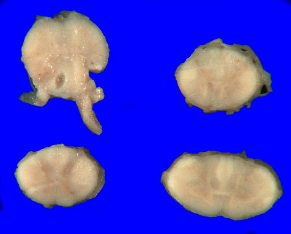 4D1 Lymphoma, IV (Case 4) myelitis 10