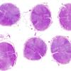 4D2 Lymphoma, IV (Case 4) myelitis N11 H&E whole mount