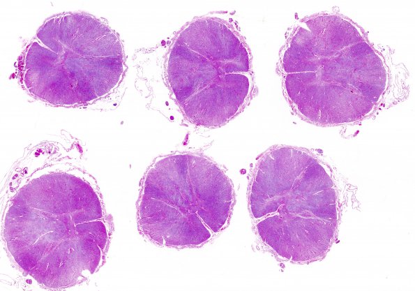 4D2 Lymphoma, IV (Case 4) myelitis N11 H&E whole mount