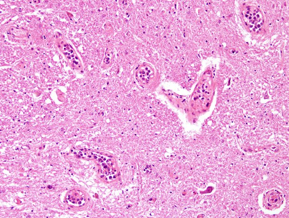 4D4 Lymphoma, IV (Case 4) myelitis H&E 4