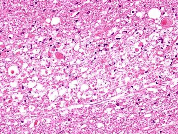 4D7 Lymphoma, IV (Case 4) myelitis H&E 22