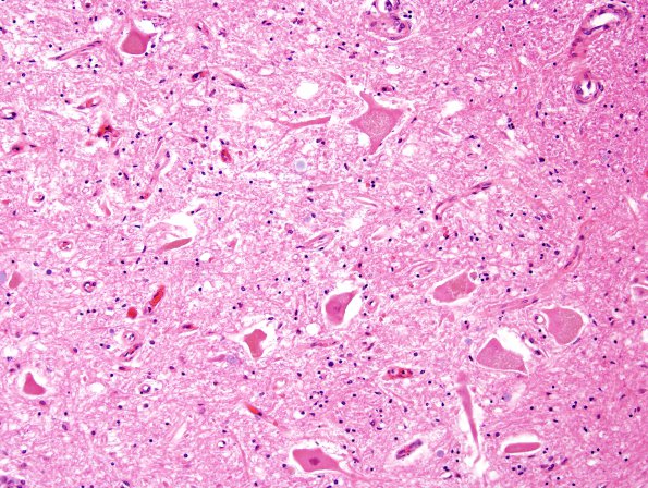 4D8 Lymphoma, IV (Case 4) myelitis H&E 29