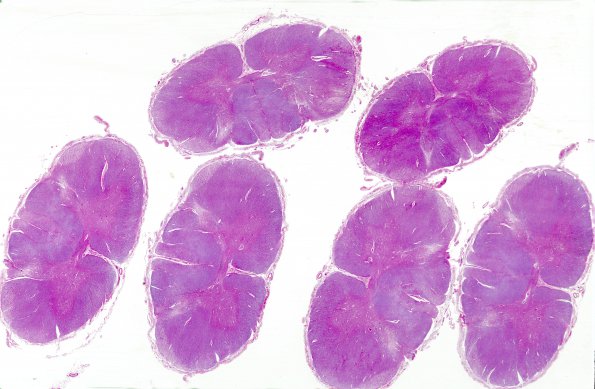 4E1 Lymphoma, IV (Case 4) myelitis N10 1 H&E WM