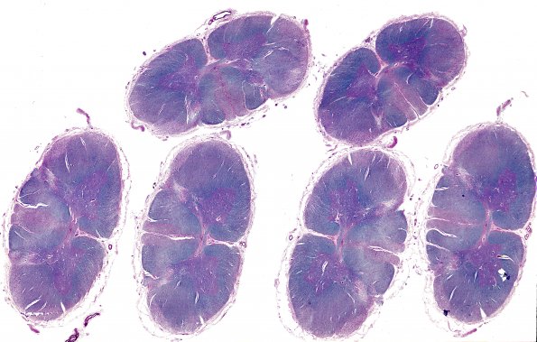 4E2 Lymphoma, IV (Case 4) myelitis N10 1 LFB-PAS whole mount