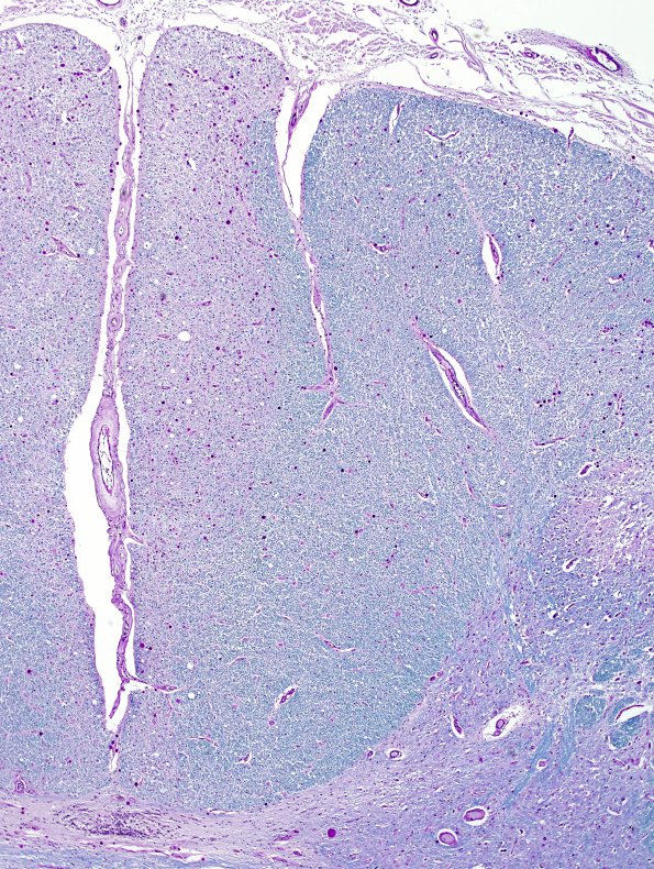 4E4 Lymphoma, IV (Case 4) myelitis N10 Dorsal column LFB-PAS 1