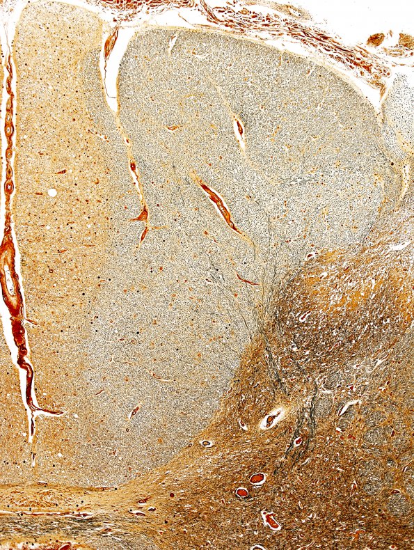 4E5 Lymphoma, IV (Case 4) myelitis N10 Dorsal column Biels 1