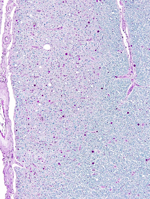 4E6 Lymphoma, IV (Case 4) myelitis Dorsal column LFB-PAS 2